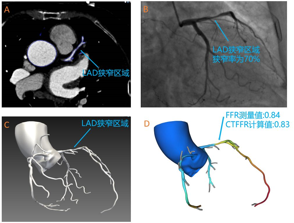 奧泰康助力睿心醫療—《冠狀動脈供血功能（CT-FFR）評估軟件》產品完成創新審評及臨床試驗