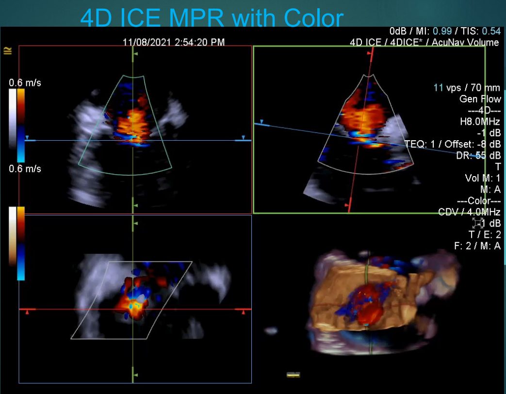 術中超聲成像新技術|心腔內超聲（ICE）②市場研發篇