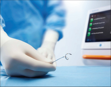  RDN | 經腎動脈去交感神經術——高血壓微創介入治療