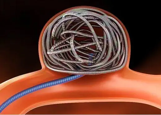  MA市場準入 | 神經介入②顱內彈簧圈系統-臨床評價路徑