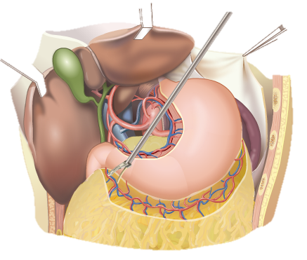 前研 | 外科止血超聲刀類產(chǎn)品臨床及注冊